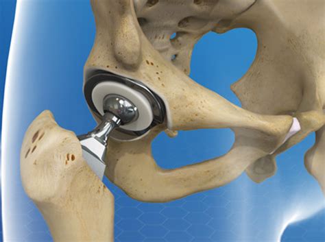 Video Total Hip Replacement Metal On Metal With Liner Healthclips