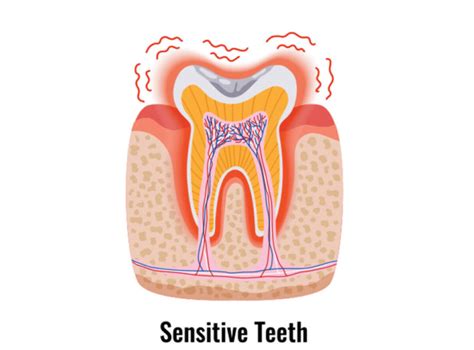 sensitive teeth dentist brisbane