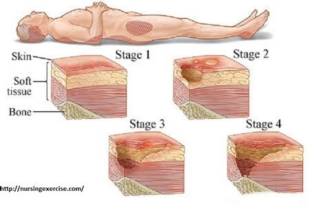Stages Of Bedsore Pressure Sores Complications