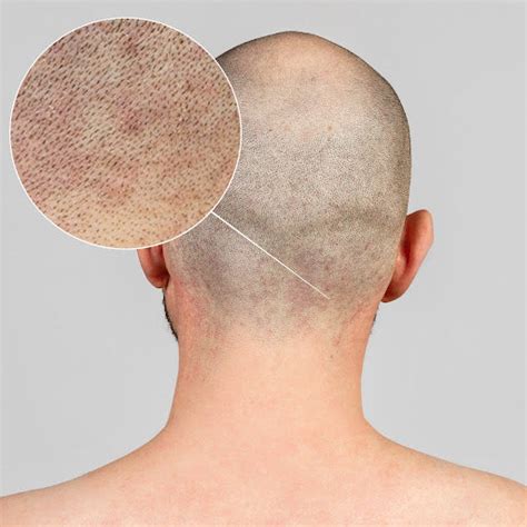 Top 13 Ways To Stop Shaving Rash On Head New Research 2023 Skull