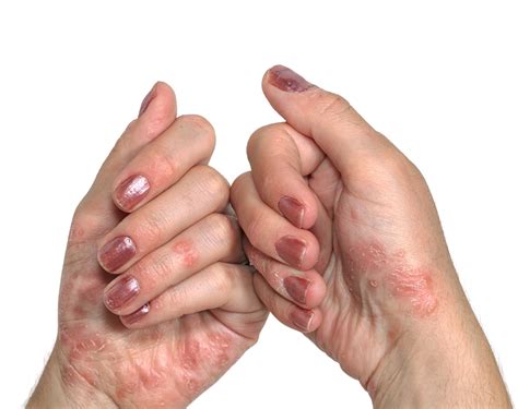 Osteoarthritis Risk Higher Among Patients With Psoriatic Arthritis Than