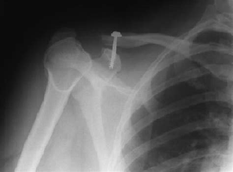Post Traumatic Osteolysis Of The Clavicle Eurorad