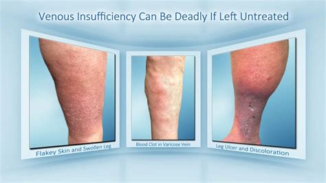 Venous Insufficiency Is A Deadly Vein Disease That Is Affecting More