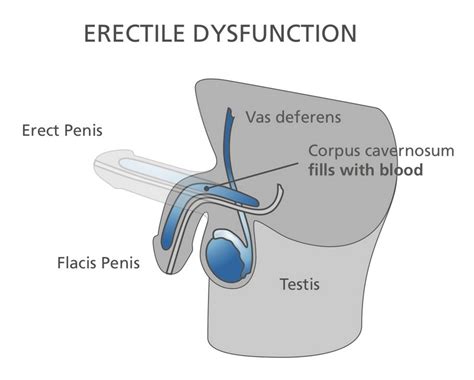 Erectile Dysfunction Causes Symptoms Medications Online Canadian