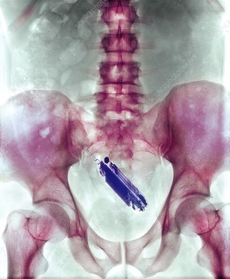 We did not find results for: Mobile phone in a person's rectum, X-ray - Stock Image ...