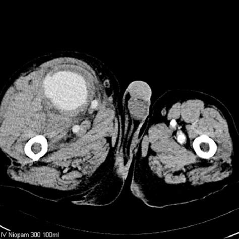 Axial Contrast Enhanced Ct Image Of The Upper Thighs Demonstrating The