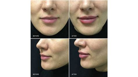 Juvederm Before And After Change Comin