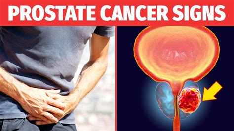 Prostate Cancer Warning Signs Common Causes Of Prostate Cancer Youtube