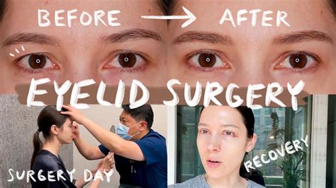 Eyelid Surgery In Korea 👁️👁️ 🇰🇷 Plastic Surgery And Recovery Vlog