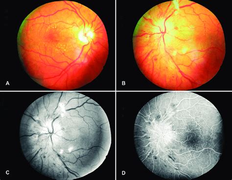 Fundus Photographs Of Both Eyes And Red Free As Well As Fluorescein