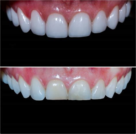 8 Key Benefits Of Teeth Contouring Reshaping For Perfect Smile