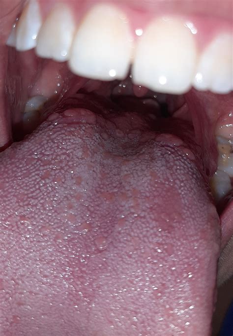 Bultos en la garganta - CCM Salud
