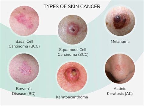 Symptoms Of Skin Cancer Risk Factors Signs And Causes My Health Only