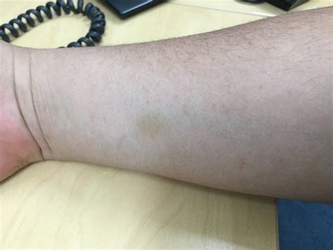 Random Yellow Spot On My Forearm Askdocs