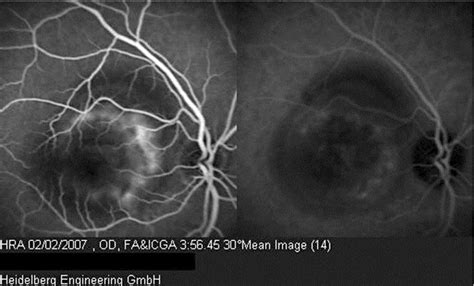 Figure 2 From Intravitreal Bevacizumab For Photodynamic Therapy Induced