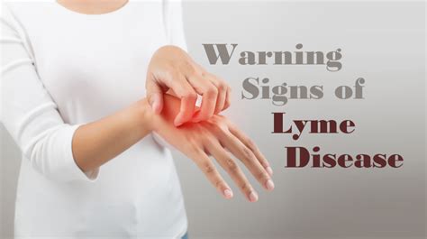 Early Warning Signs Of Lyme Disease Womenworking