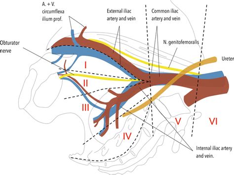 Anatomical Regions Involved In Lymph Node Dissection I External Iliac
