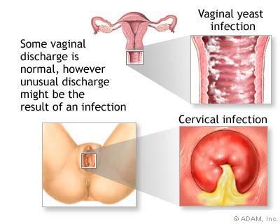 The New York Times Health Image Vaginal Discharge