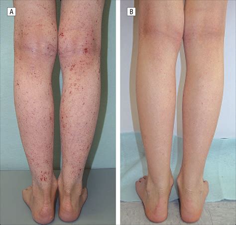 Successful Treatment Of Severe Atopic Dermatitis In A Child And An