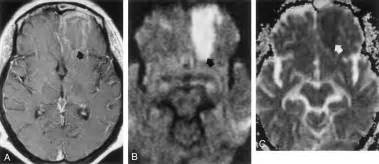 Diffusion Weighted Imaging Of Cerebritis American Journal Of