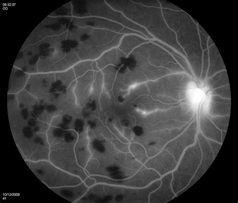 Red Free Retinal Vasculitis Retina Image Bank