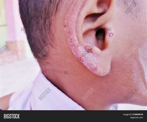 Ear Skin Infection Image And Photo Free Trial Bigstock