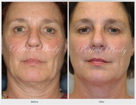 Thermage™ Non Surgical Cosmetic Skin Tightening And Volume Reduction