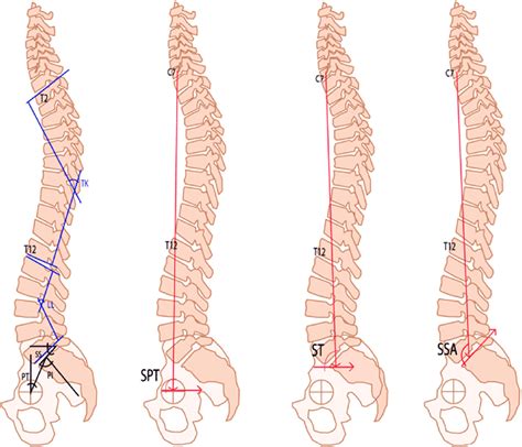 Angle Measurements In Full Length Spine Radiographs Pelvic Incidence