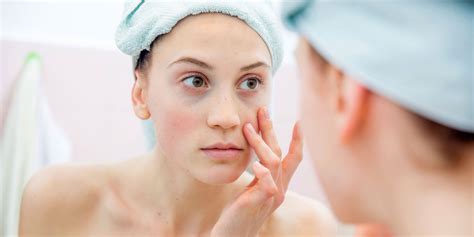 Knowing When To See A Dermatologist For Acne Taza Coffee