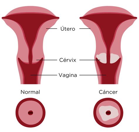 Cancro Cervical