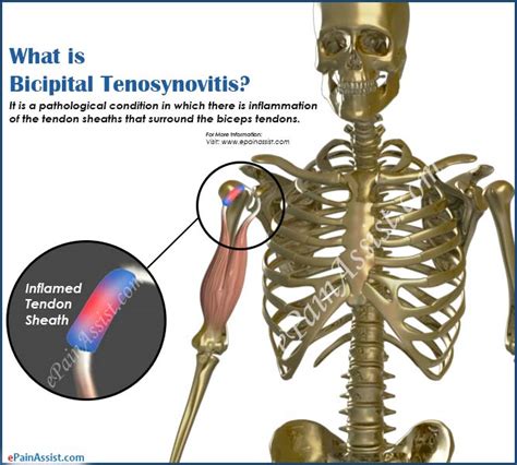 What Is Bicipital Tenosynovitis And How Is It Treated