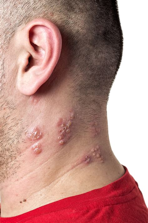 Shingles Are You At Risk Medical Alert Lifefone