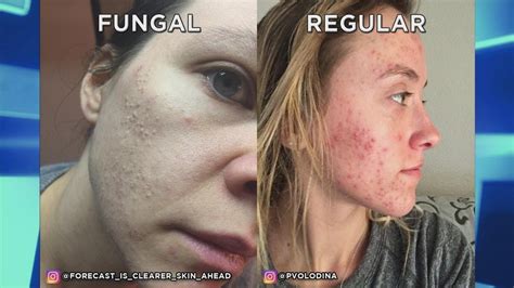 What fungal acne looks like versus regular acne. How is Fungal Acne Different Than Traditional Acne? - YouTube