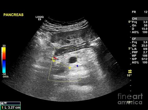 Secondary Pancreatic Cancer Ultrasound Photograph By Science Photo