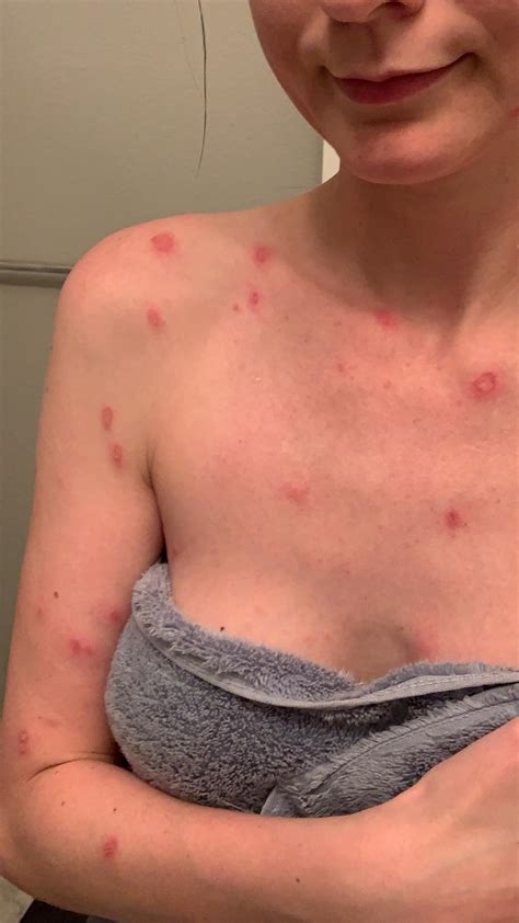 Help! I wore a new coat and this happened. One doctor thinks it's dermatitis. One thinks it's 