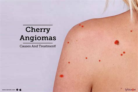 Blood Spots Cherry Angioma Vs Petechiae 301 Moved Permanently Early