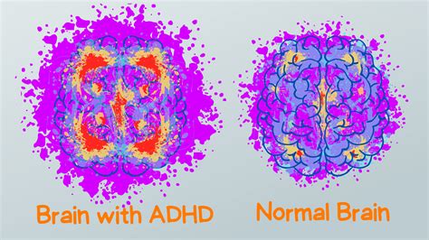 Adhd Brain Differences