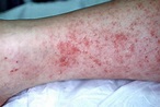Rocky Mountain Spotted Fever - Dermatology Advisor