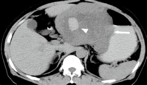 Ct And Mr Imaging Of Gastrointestinal Stromal Tumor Of Stomach A