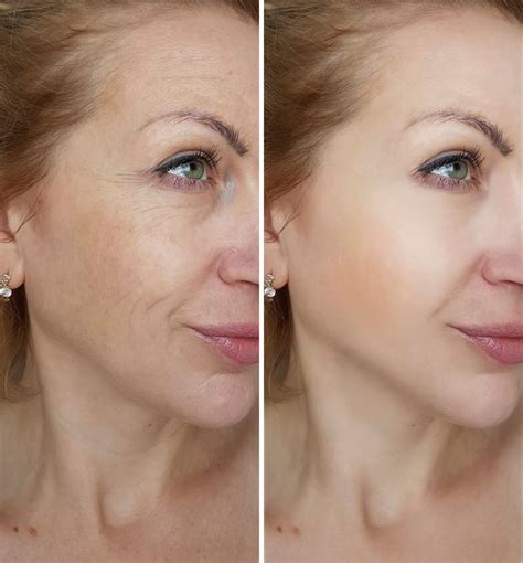 Laser Skin Treatment Before And After Your Magazine Lite