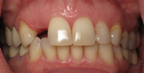 Shaping And Forming Gum Around Front Teeth Dental Implants Ramsey