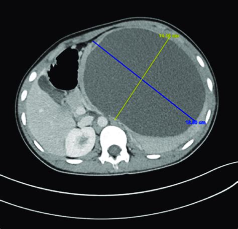 Axial View Of The Abdominal Computed Tomography Scan Revealing An