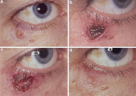 Treatment Of Basal Cell Carcinoma Of The Eyelids With 5 Topical