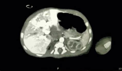 Contrast Enhanced Ct Scan Showing Early Peripheral Enhancement With