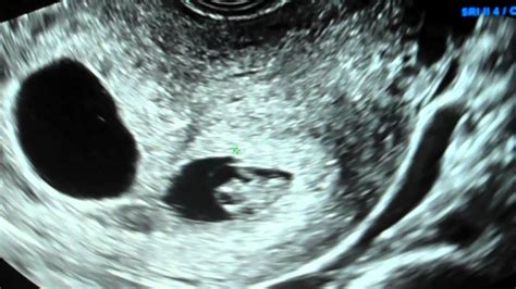 8 Week Ultrasound Twins With Heartbeats Ivf Youtube