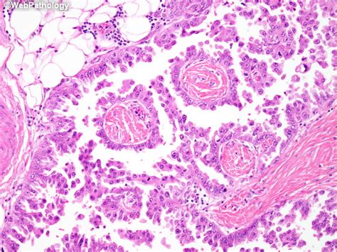 Malignant pleural mesothelioma (mpm) is a rare orphan disease associated with prior exposure to asbestos, with a dismal prognosis. Webpathology.com: A Collection of Surgical Pathology Images