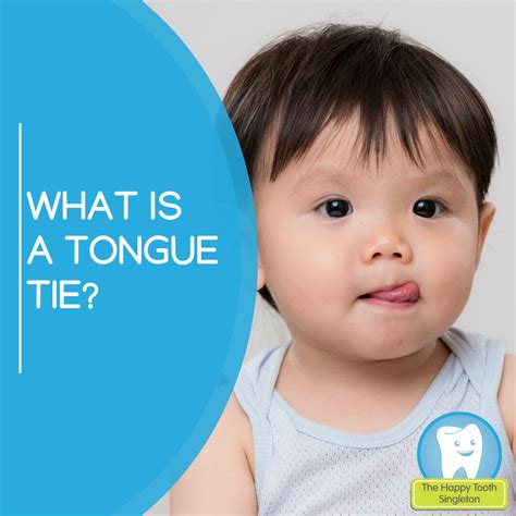 What Is A Tongue Tie The Happy Tooth Singleton