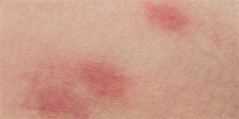 Skin Rash Symptoms Causes Diagnosis And Treatment Natural Health News