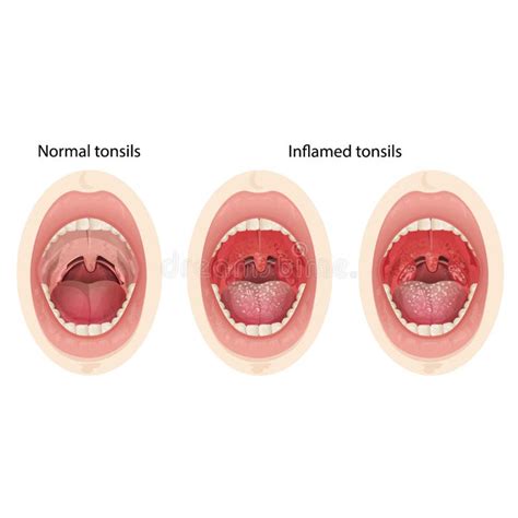 Inflamed Tonsils Stock Illustrations 52 Inflamed Tonsils Stock