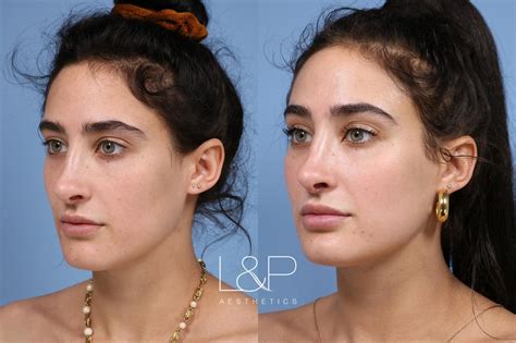Facial Fillers Before And After Photo Gallery Palo Alto And San Jose California Landp Aesthetics